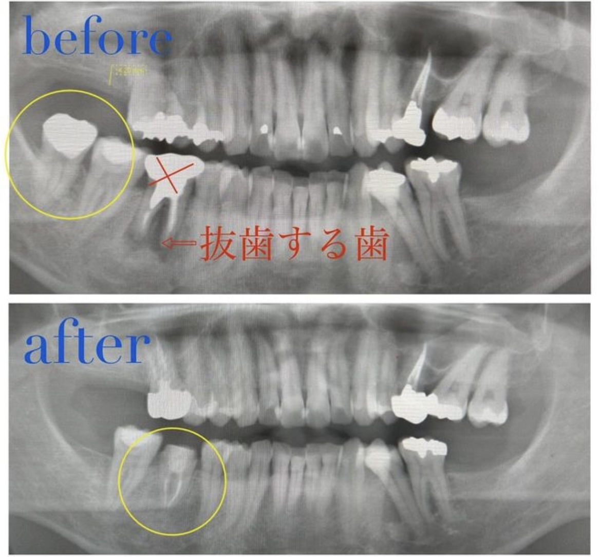 歯牙移植について - ココロ南行徳歯科クリニック