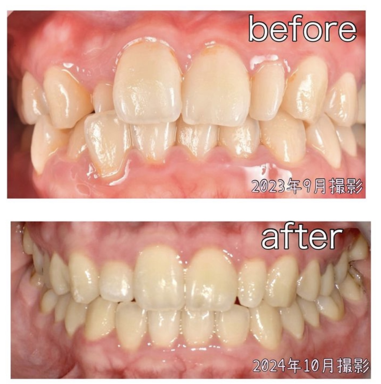 インビザラインgo 症例 - ココロ南行徳歯科クリニック